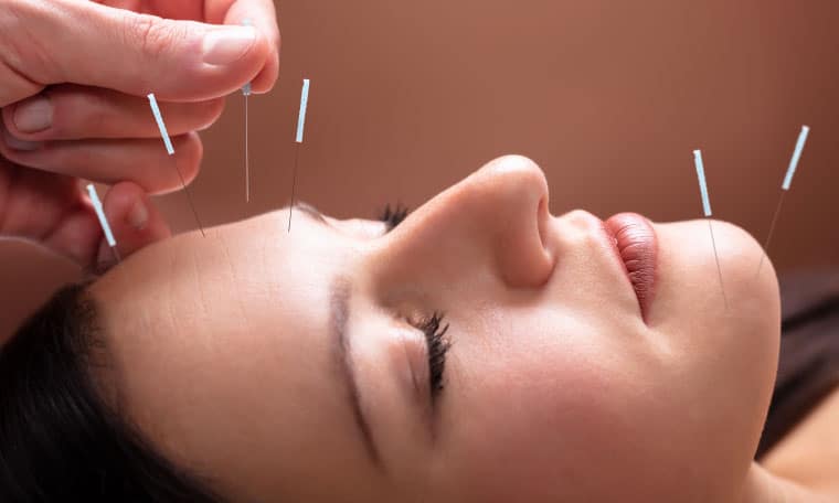 Acupuncture Facelift rejuvenations
