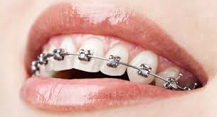 dental braces Thousand Oaks CA