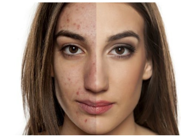 wart treatment Orange CA