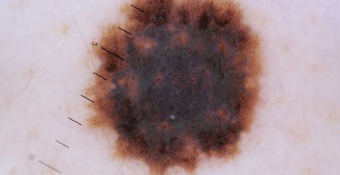 wart treatment Huntington Beach CA