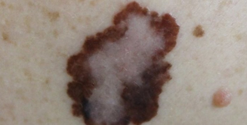 wart treatment costa mesa ca